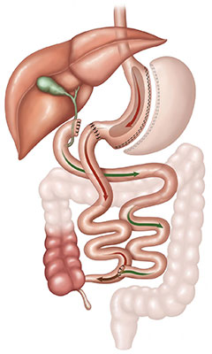 duodenal-switch